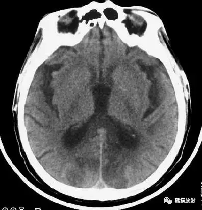 一文全腦梗死演變血供區域分佈ct表現