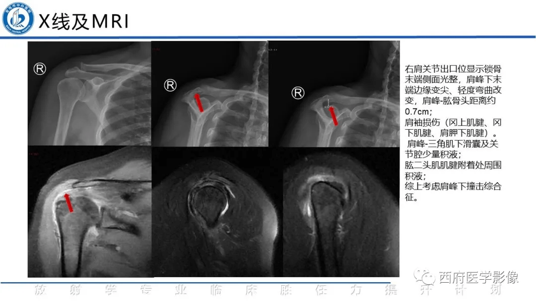 肩峰下撞击综合征影像断与鉴别诊断