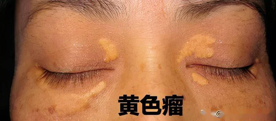 桔青霉penicilliumcitrinum他汀降脂作用的发现