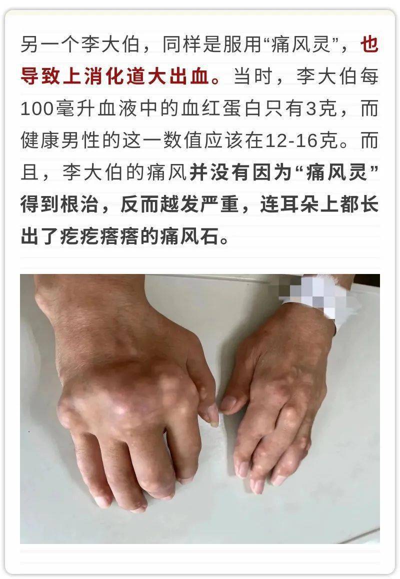 据了解这些在患者中流行的"痛风灵""风痛灵""风湿
