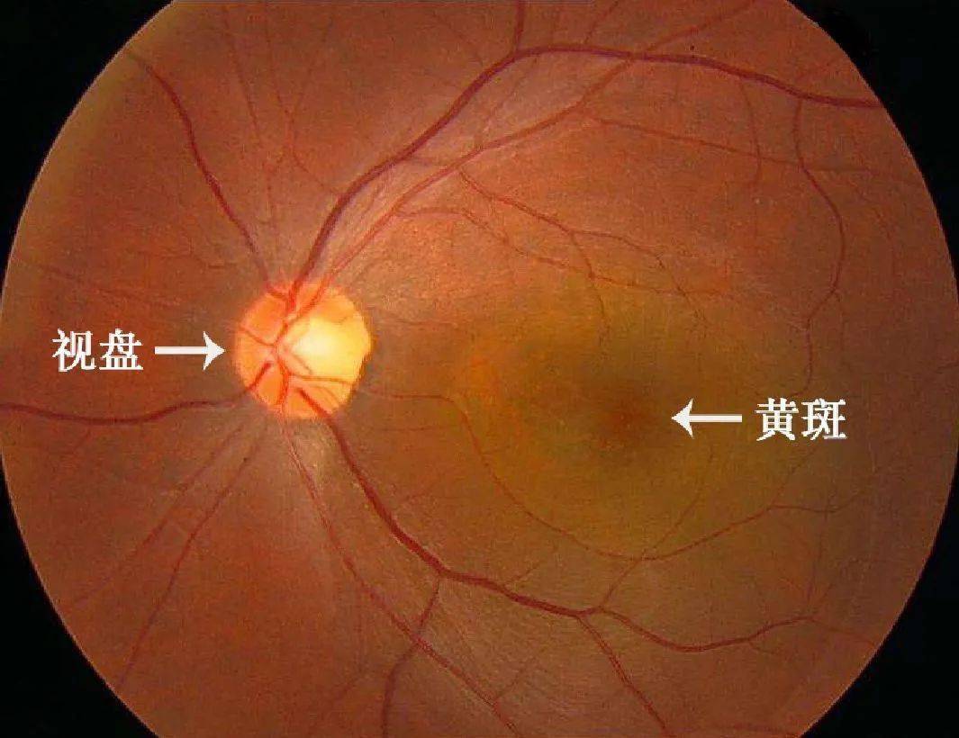 是老眼昏花還是黃斑病變一招識別早期黃斑病變