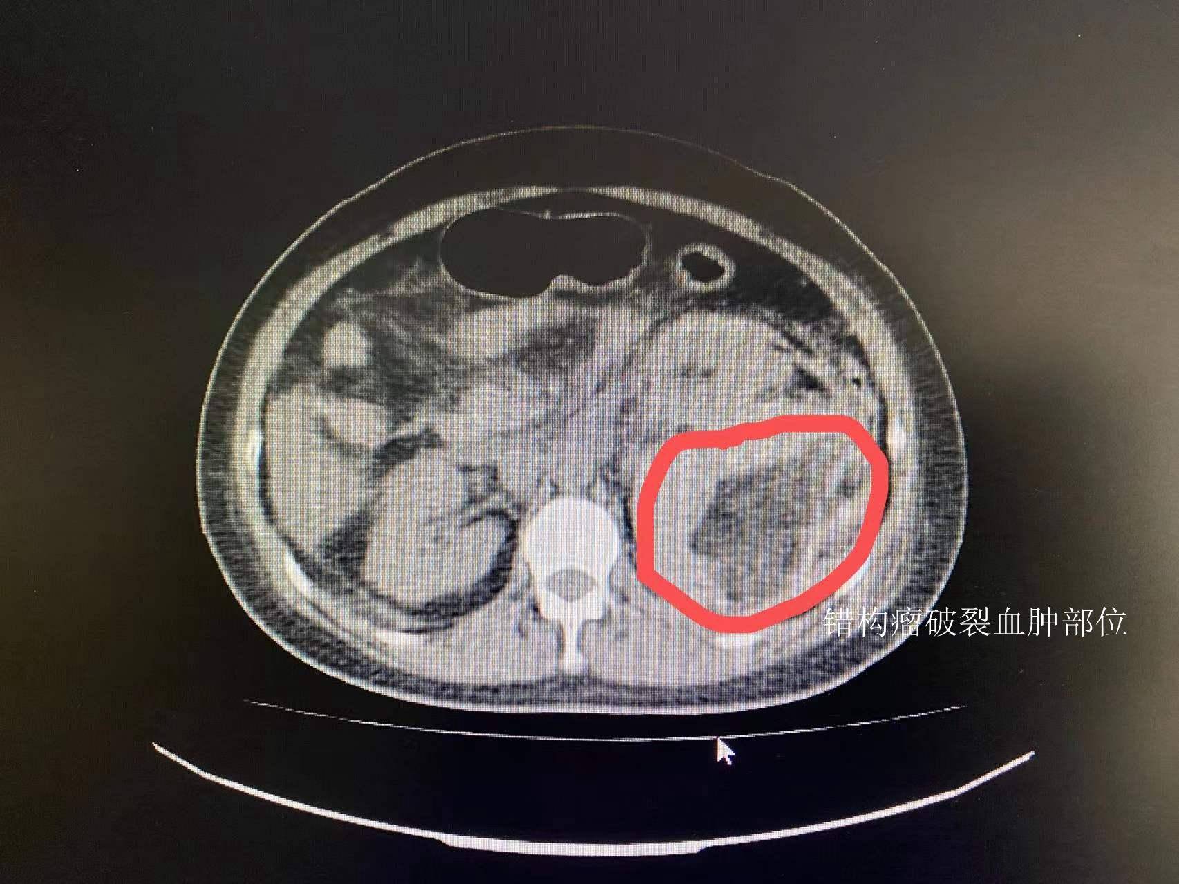 当地医院就诊,经ct检查发现李女士左肾出血,考虑为左肾错构瘤破裂出血