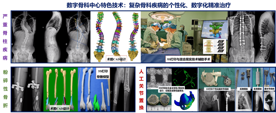 个性化|【名院名医】姚庆强：数字骨科带来个性化、精准化的骨科临床诊疗变革