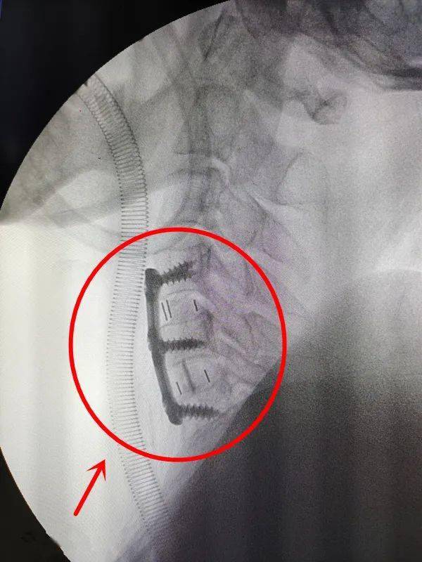 张师傅_椎间盘_颈椎