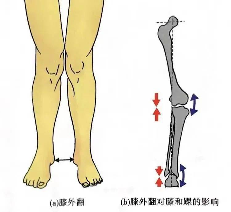 5大膝關節異常解剖學分析_髕骨_評估_姿勢