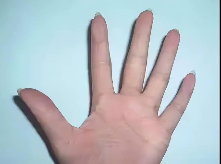 「杏林微科普」皮肤粗糙?小心是鱼鳞病哦