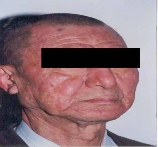 宣传日】世界麻风病日——关爱麻风患者 共创美好生活_治疗_杆菌_病人