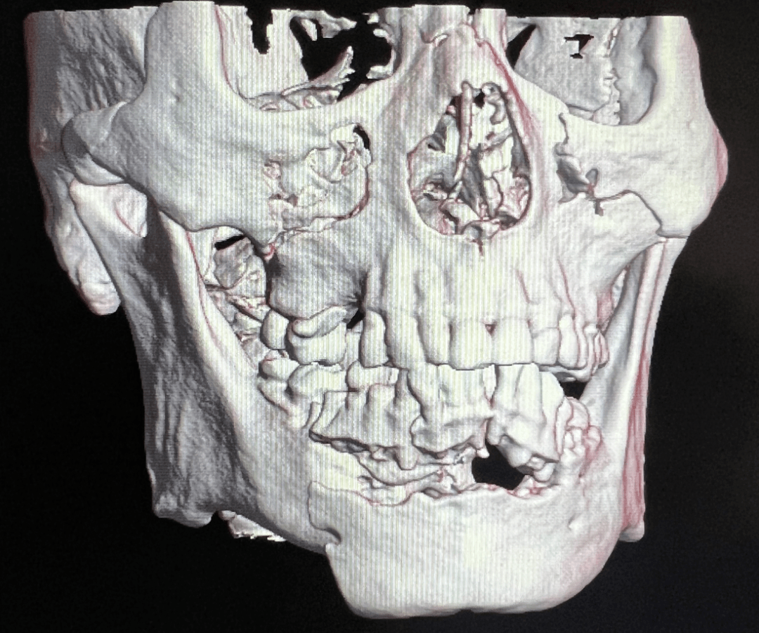 口腔科再次完成高难度头皮冠状切口全面部骨折四级手术