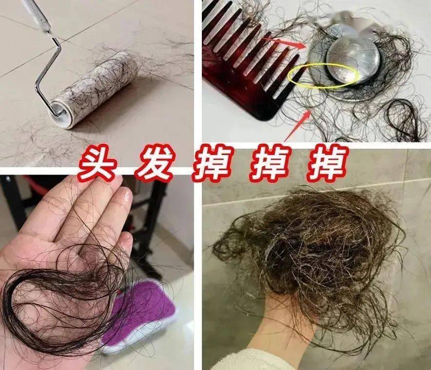 尸体头上抠下来的白泥竟是螨虫尸体！头痒头屑出油多，用它就对了