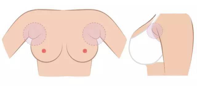 【副乳】什么是副乳_副乳的危害有哪些