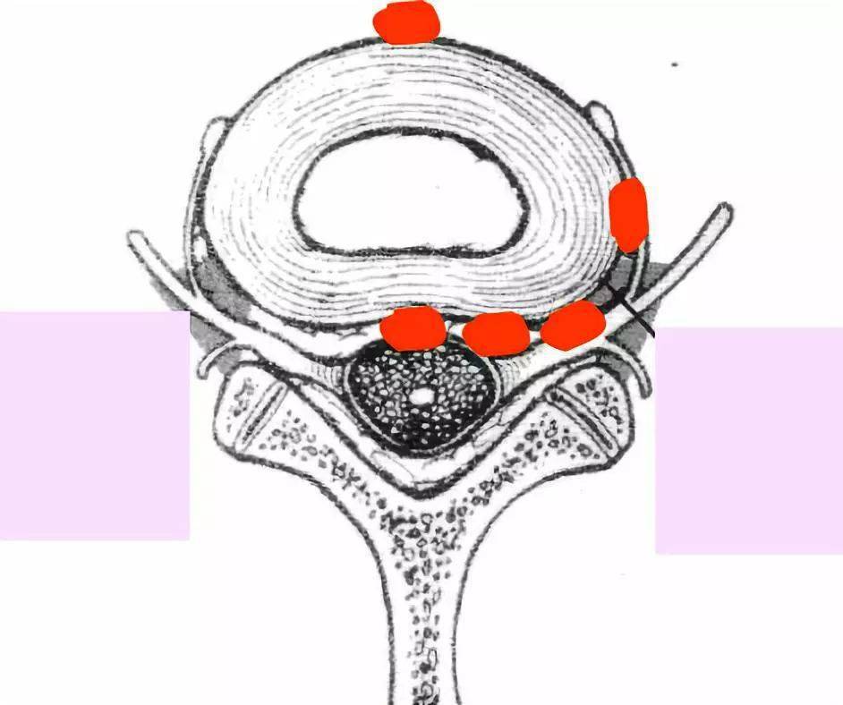 這6 種「椎間盤突出」的影像徵象別忽視!_脊柱_課程_指南