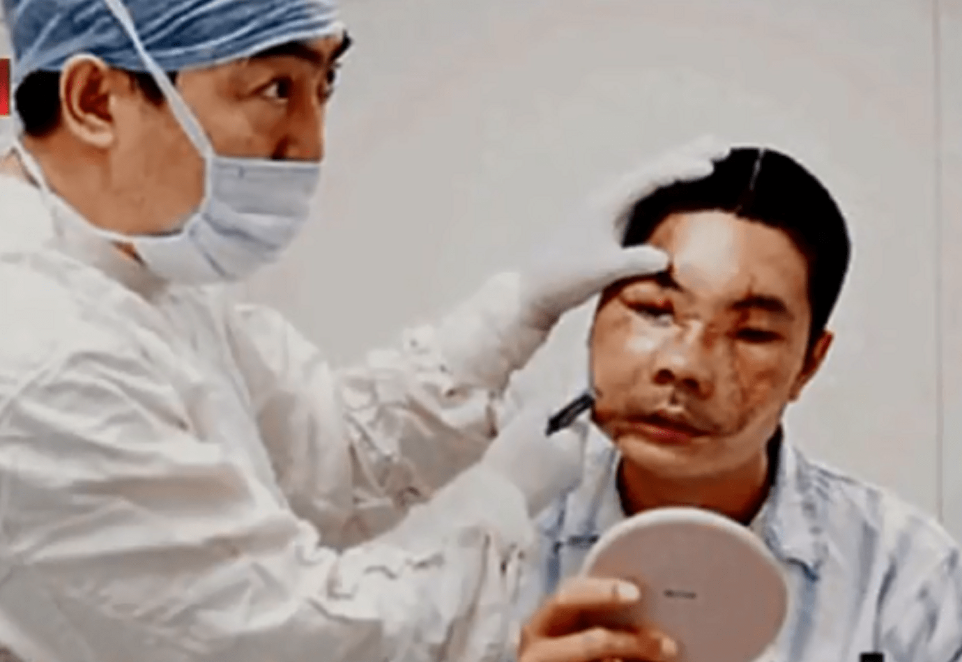 李国兴换脸手术全过程图片