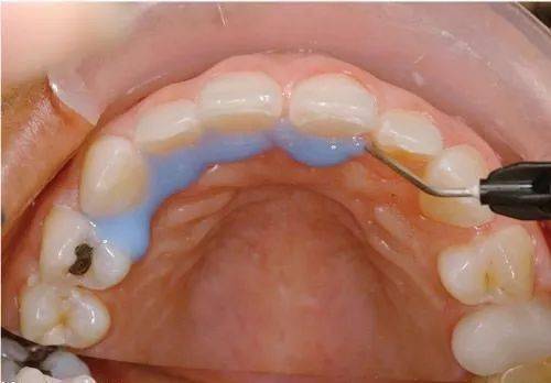 不磨牙瓷贴面的真实操作_牙齿_树脂_抛光