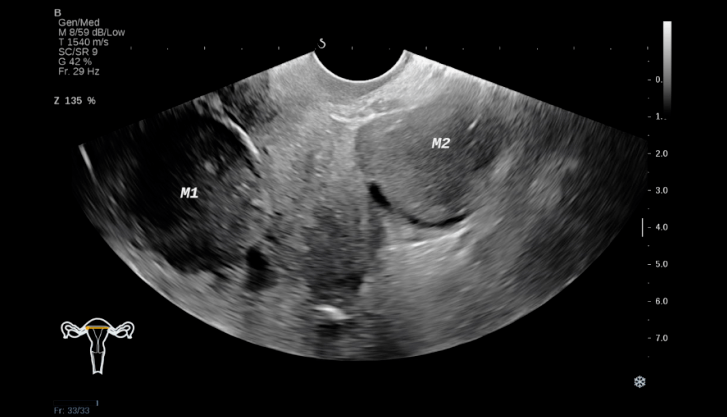 卵巢肿瘤图片b超图片