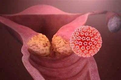 hpv感染是什么状况 becdba9332c54763a0d39a639c45f1aa.jpeg