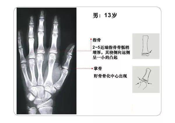 收藏必备丨骨龄图谱_risser_骨骼_中心