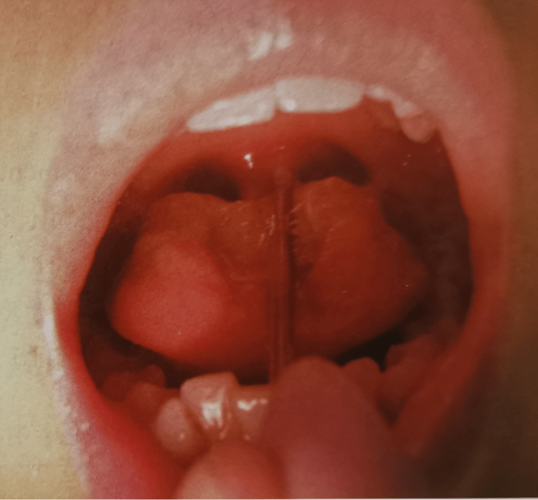 嗓子哑是新冠肺炎的症状吗