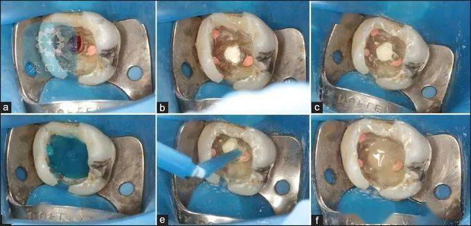 髓室底穿原因及治疗处理