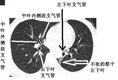 支氣管告密這個肺部ct有問題