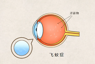 眼前老有蚊子飞?当心是这种眼病!_玻璃体_王晓波_视网膜