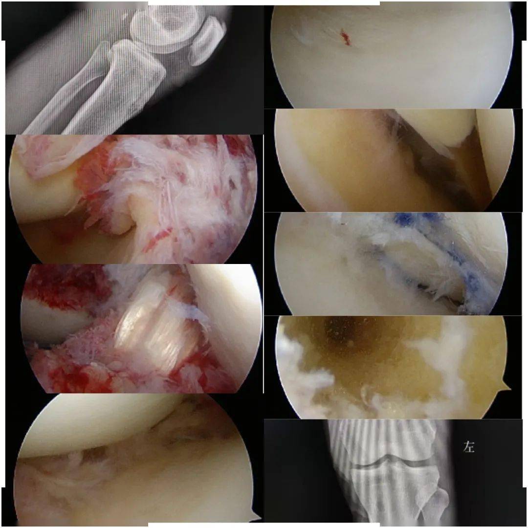 腰椎融合術acl重建 內外側半月板縫合骨盆骨折 關節鏡【中醫院骨傷科
