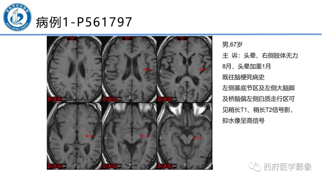 华勒氏变性的影像诊断