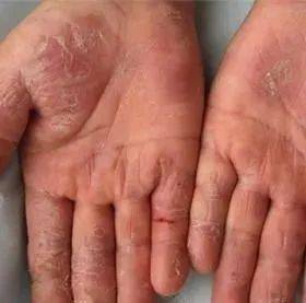 导致手掌皮肤受到了癣菌的感染,严重的还会延伸到手背,一般来说,手癣