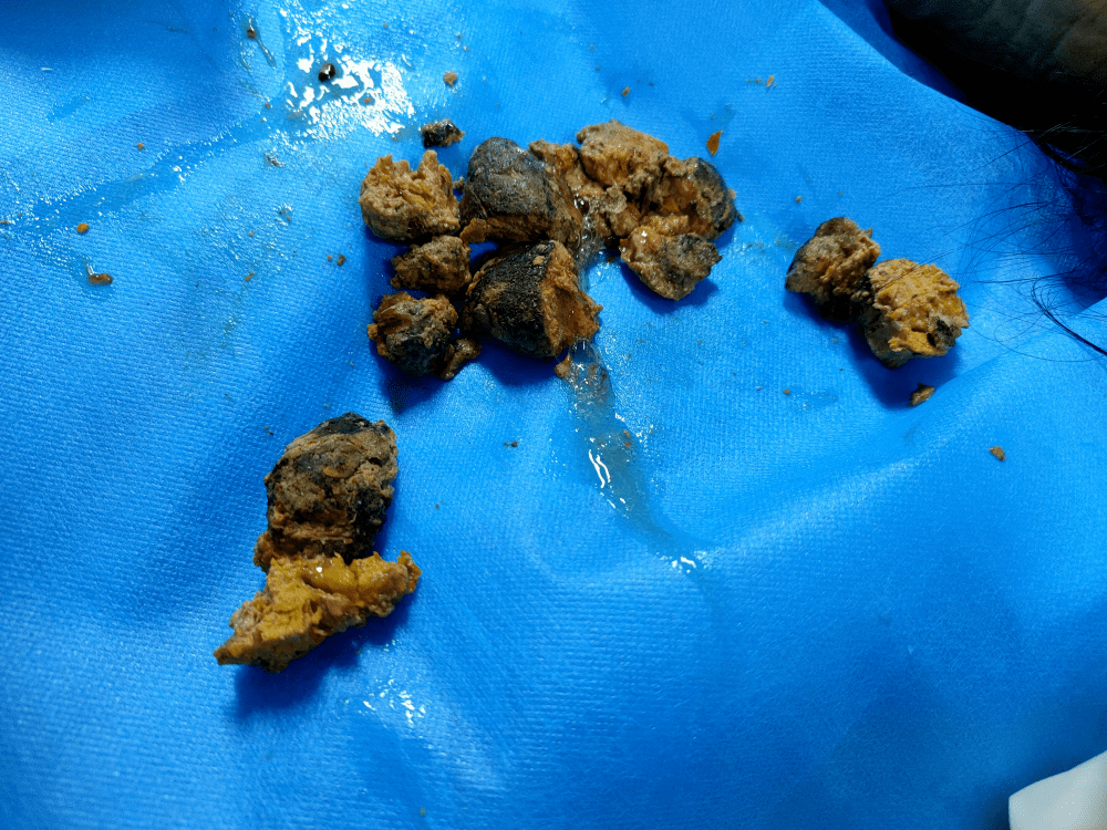 丰城一老奶奶胃里长拳头大结石竟是因为吃多了这个