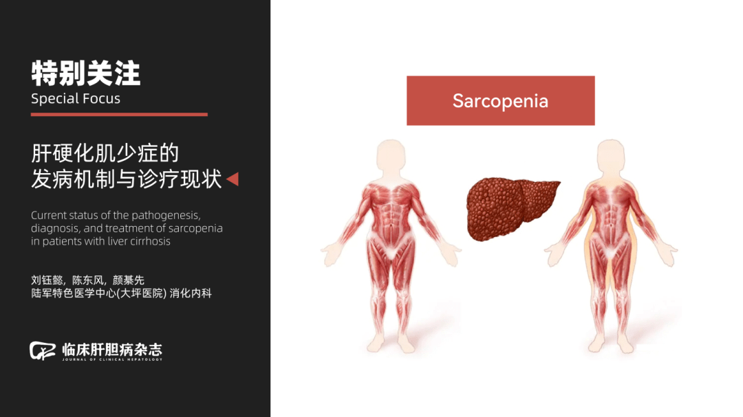 特別關注肝硬化肌少症的發病機制與診療