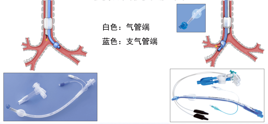 双腔支气管导管常用的肺隔离装置肺大泡,支气管胸膜瘘,肺移植和单侧肺