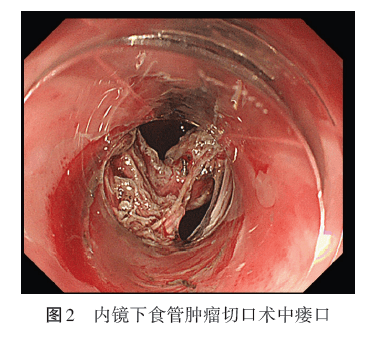 病例析評內鏡下食管腫瘤切除術中併發縱隔胸膜瘻1例