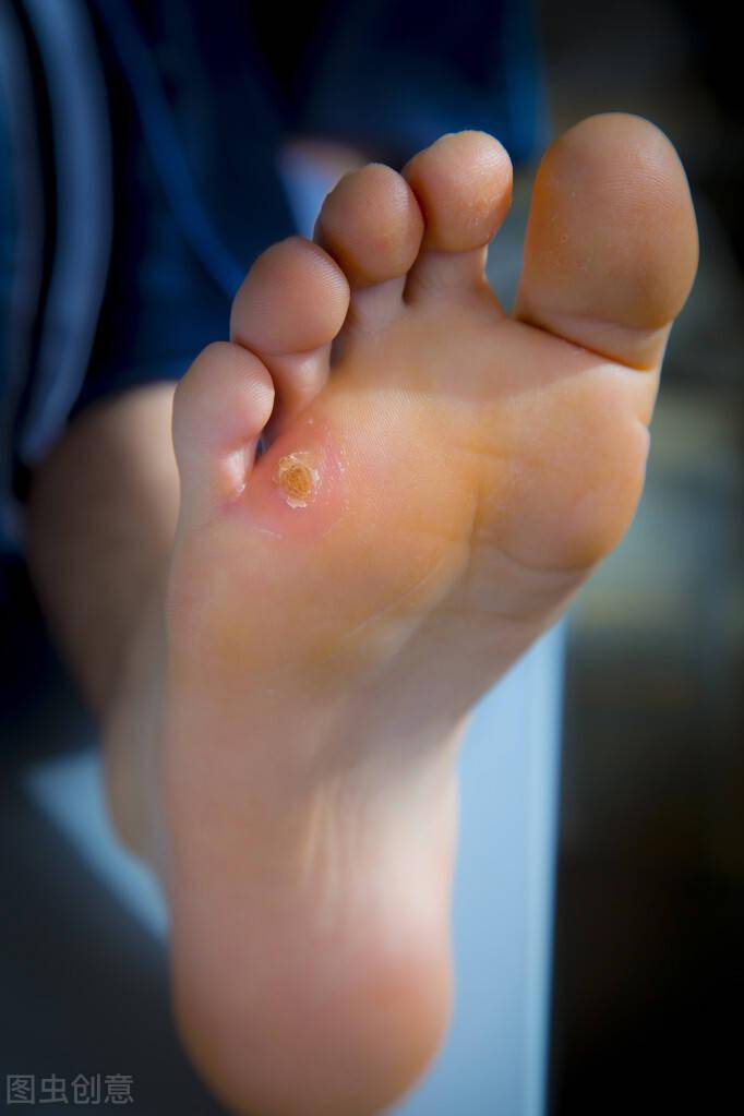 后,周围会有软化了的组织一碰就掉,可以看到鸡眼中心有新的肉芽在生长
