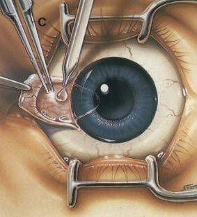 翼状胬肉的手术操作要点(内附手术)_防控_结膜_角膜