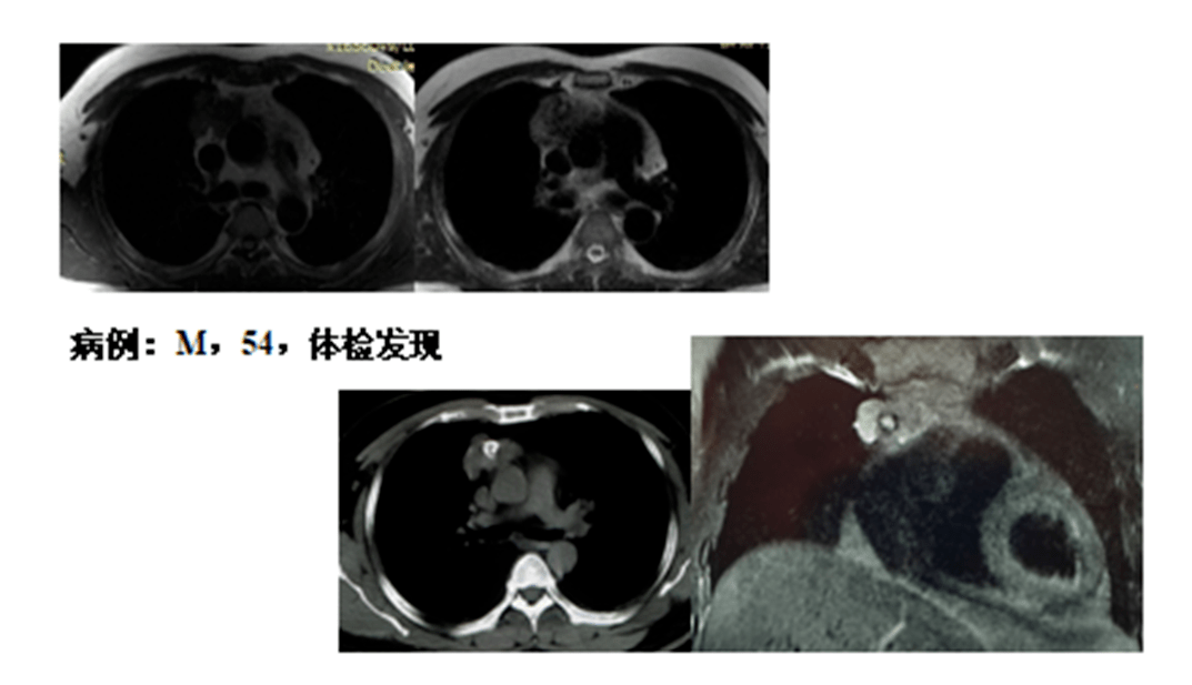 李智勇教授:见微知著-纵隔病变的mri成像_诊断_肿瘤_神经