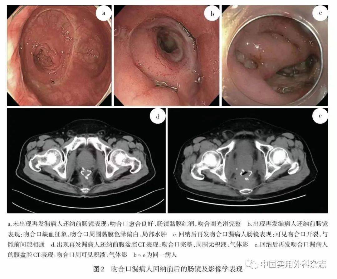 5个月;临床表现为骶前脓肿并继发不完全性肠梗阻(4例),反复发作肛周