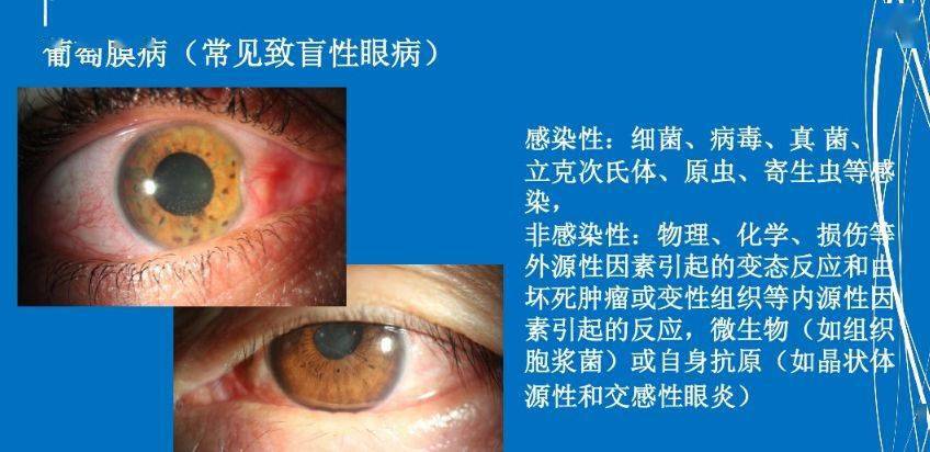 眼睛与全身疾病的关系