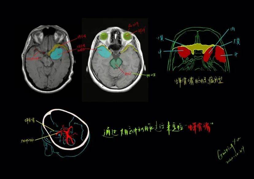 徐桂興|顱腦解剖影像手繪_蝶骨_定位_博士