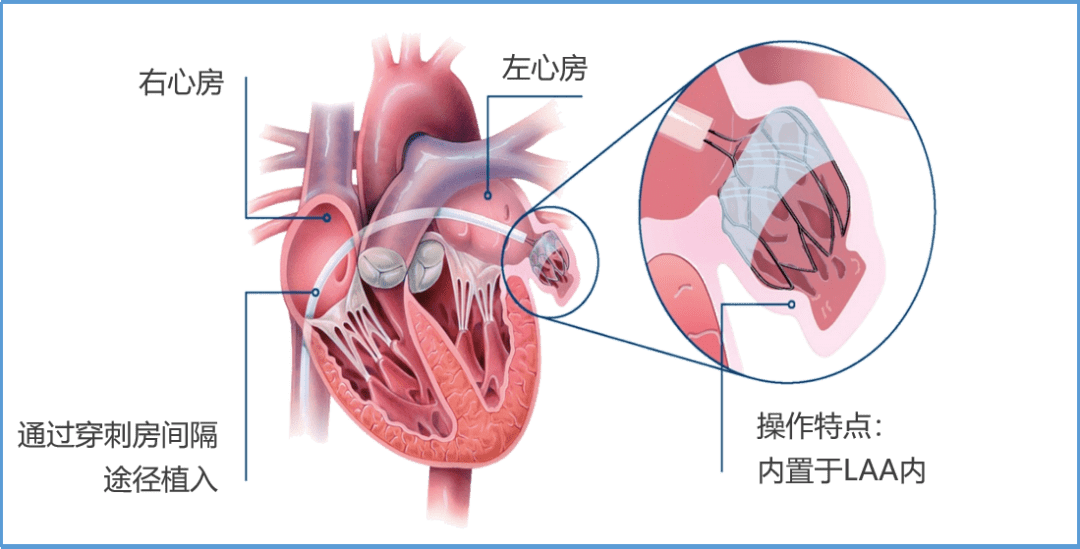 右心耳解剖图图片