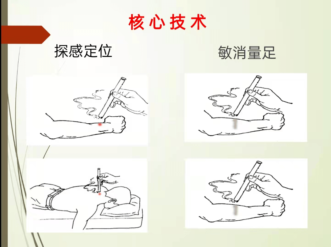 穴位|【医文医话】针灸二科：你了解热敏灸吗？