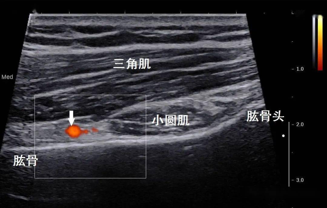 超聲解剖61一把勺子腋神經的超聲解剖