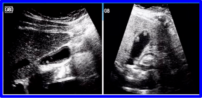 金小鸥讲健康 | 胆囊息肉样病变=胆囊癌?_超声_造影_癌变