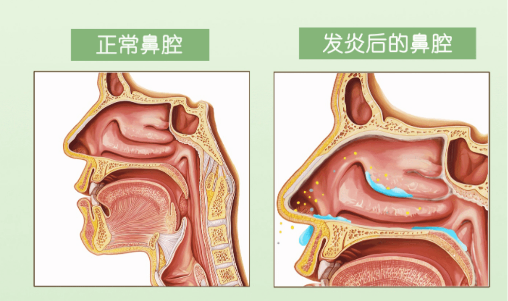 鼻炎内部图片高清图片