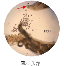 合并|一例分析 | 类风湿关节炎患者合并「钩虫感染」