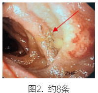 合并|一例分析 | 类风湿关节炎患者合并「钩虫感染」