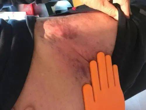 拍打腹股沟胖子减肥瘦人增重