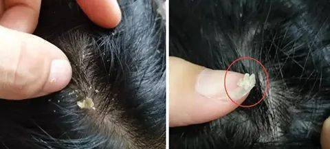 头皮头屑暴增？头皮扣下“白泥”？用Ta,帮你揪出头屑“内鬼”！清爽柔顺，发量翻一番！