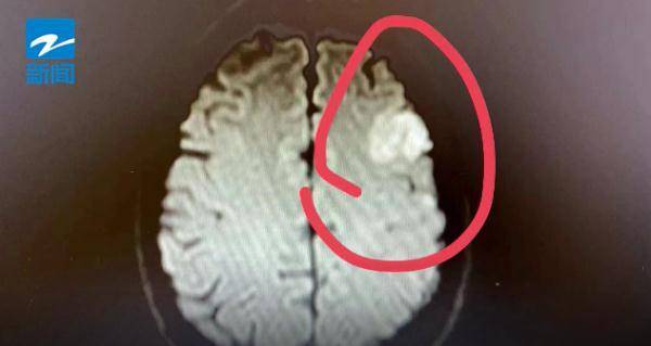 浙江省|杭州有医院6天接诊16例脑梗死病人！最近这些人一定要当心