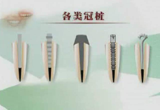 不超过根长的1/3组合式桩冠铸造桩冠烤瓷桩冠金属舌面板桩冠树脂桩冠