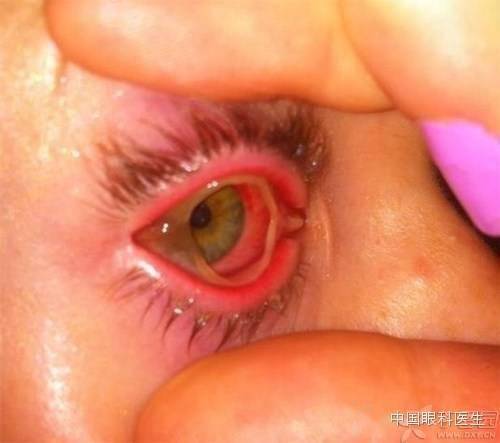 伪膜:上皮表面的凝固物,去除后上皮仍然完整真膜:严重炎症反应引起