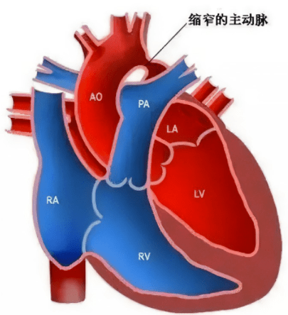 成人先天性心脏病,你知道多少?_肺动脉_患者_艾森曼格